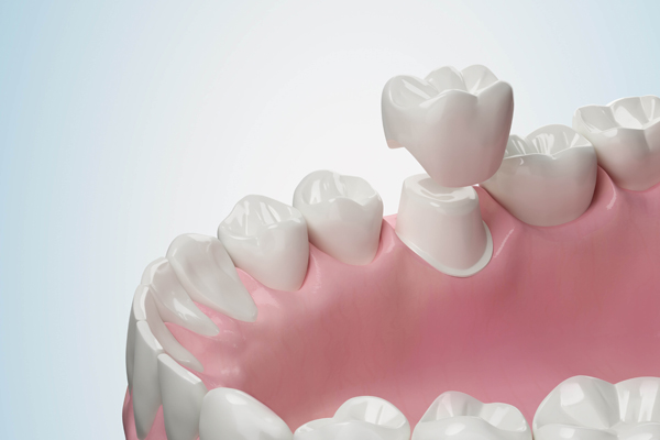 Dental Crown Types Compared: Porcelain Vs  Zirconia Vs  Metal (and How To Choose)
