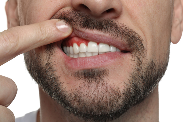 Non Surgical Vs  Surgical Gum Disease Treatment: What To Expect